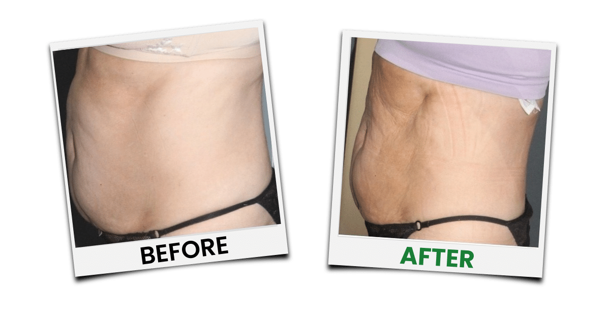 Before-and-after treatment example