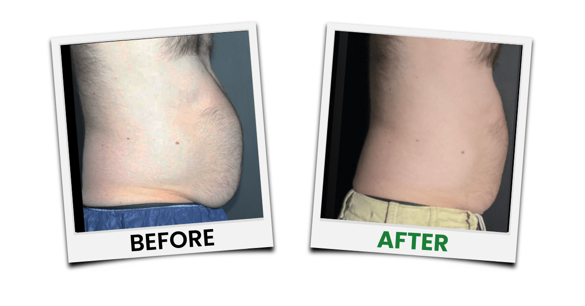 Before-and-after treatment example