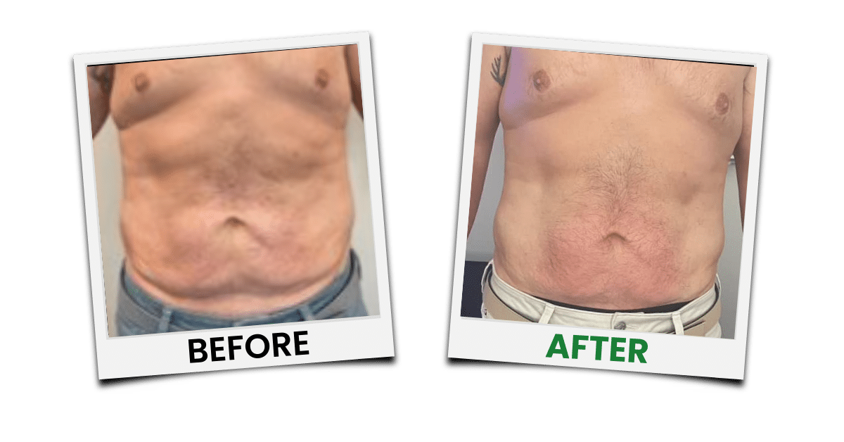 Before-and-after treatment example