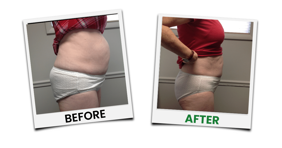 Before-and-after treatment example
