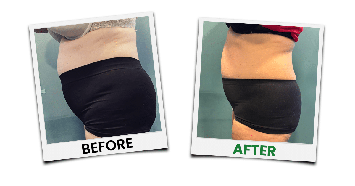 Before-and-after treatment example