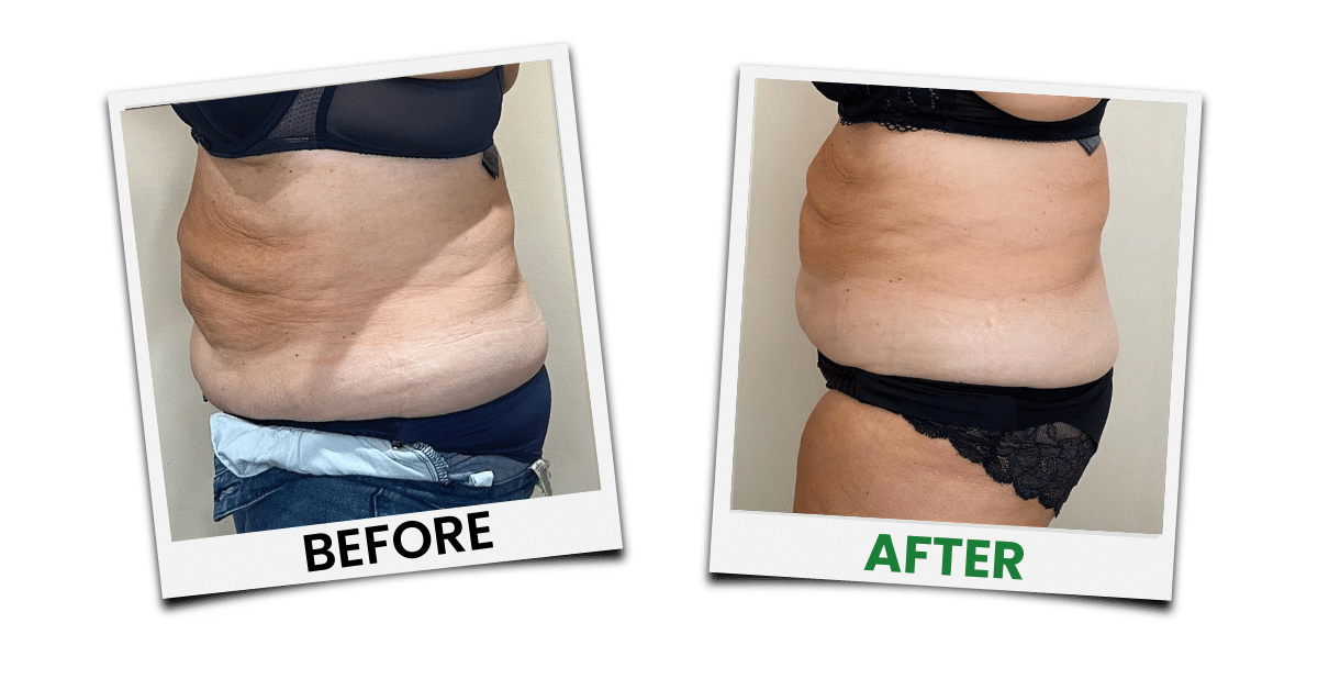 Before-and-after treatment example