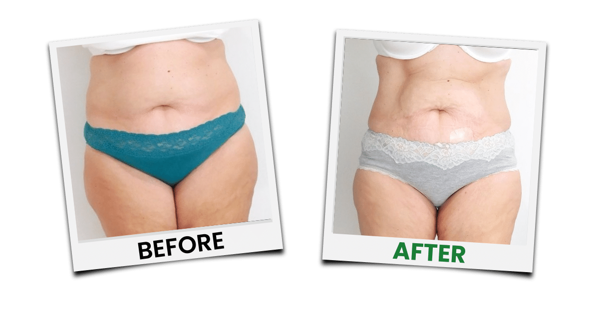 Before-and-after treatment example