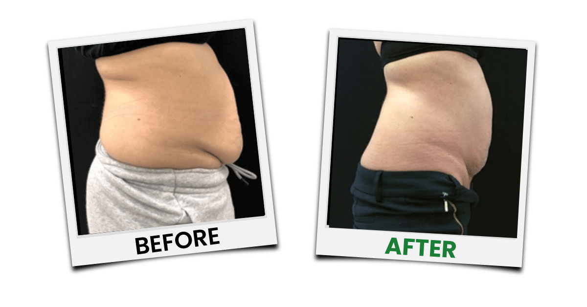 Before-and-after treatment example