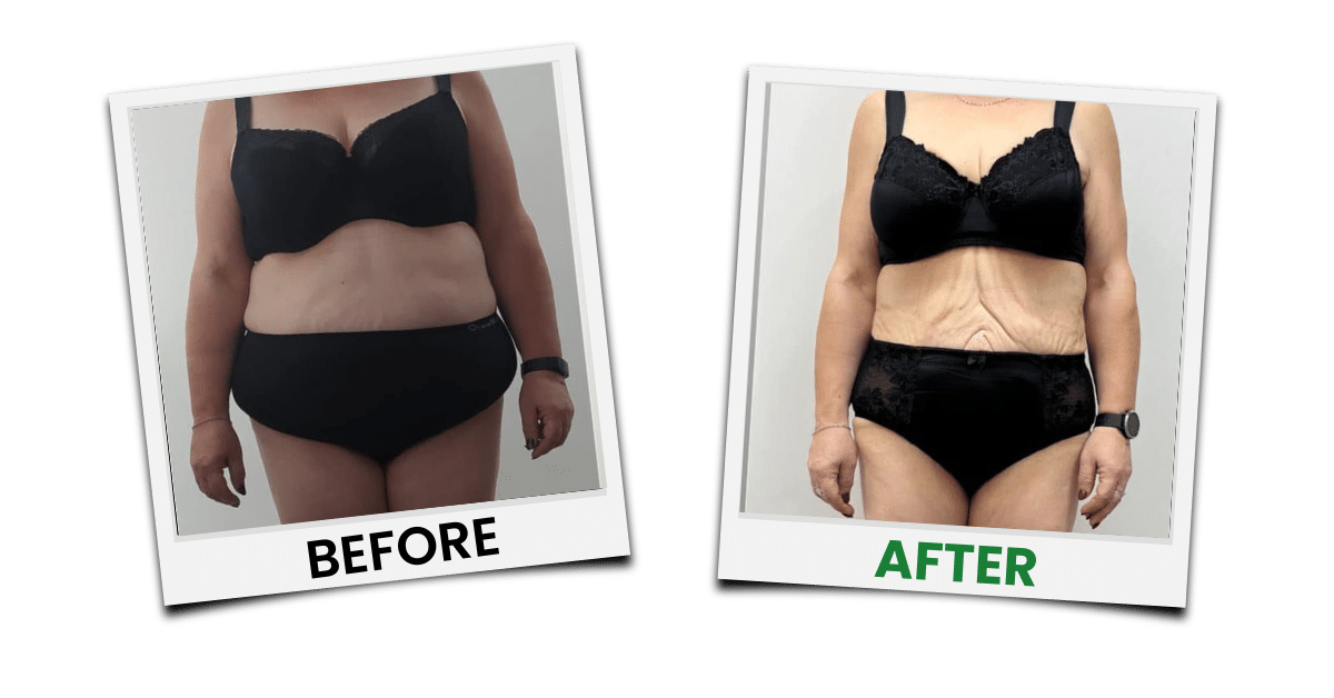 Before-and-after treatment example